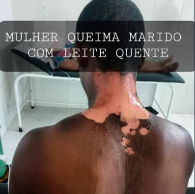 Região: Após crise de ciúmes, mulher queima o marido com leite quente